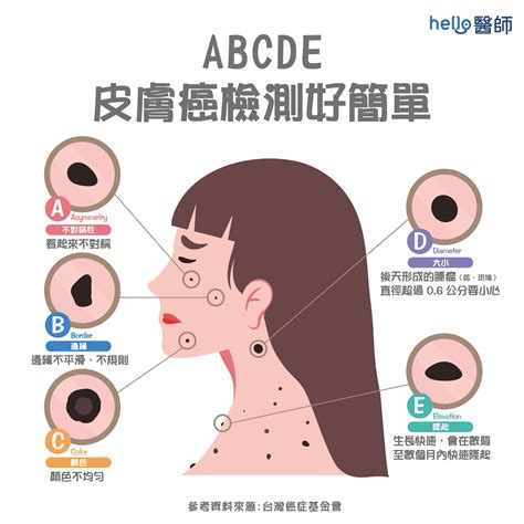 痣 顏色|痣形成的原因？痣長毛、痣變多變大是痣病變？5招判。